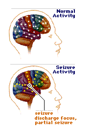 Dr.Aniruddh Kulkarni Best Neuro Surgeon epilepsy seizure